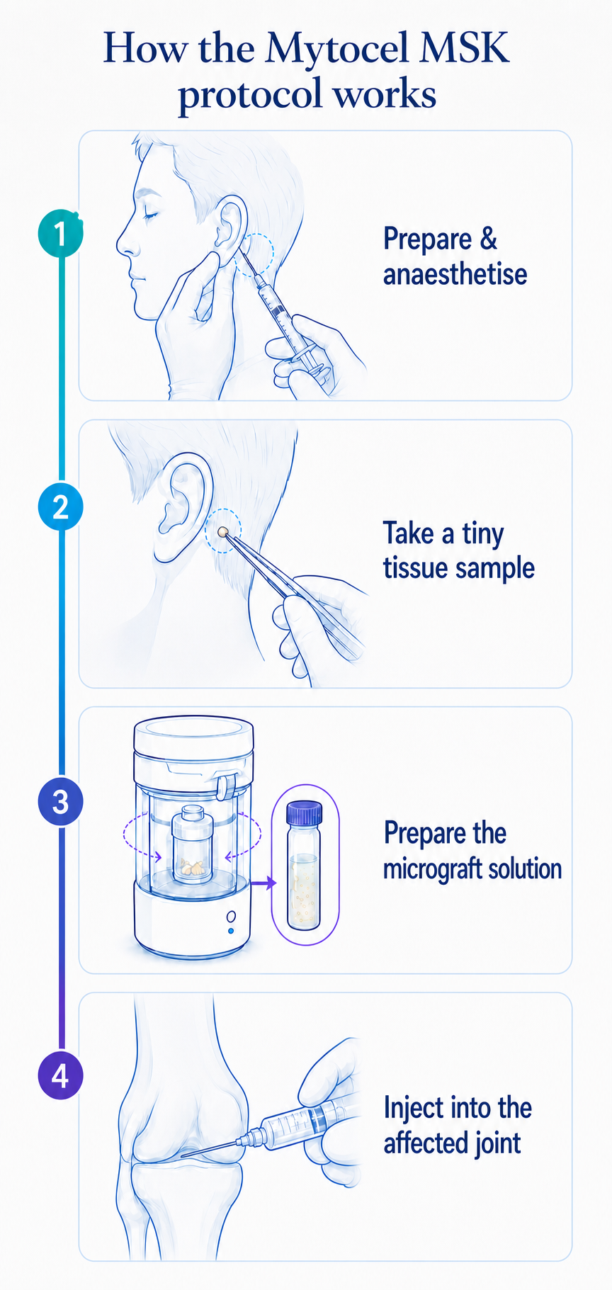 Four-step Mytocel MSK protocol showing anaesthetic behind the ear, a small tissue sample, preparation of the micrograft solution and injection into the knee joint.